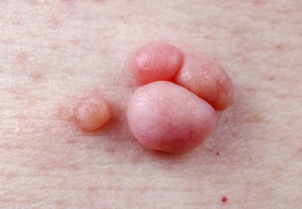 Genital Siğil (Kondilom) Belirtileri ve Tedavi Yöntemleri - Op. Dr. Mehmet Gül Antalya Manavgat genital siğil kondilom HPV lezyonu yakın çekim ve tedavi öncesi cilt görünümü